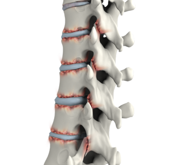  Ankylosing Spondylitis