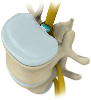 Cauda Equina Syndrome