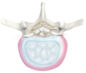 Degenerative Disc Disease