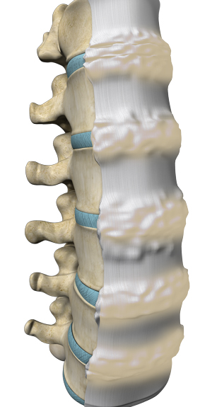 DISH (Diffuse Idiopathic Skeletal Hyperostosis)