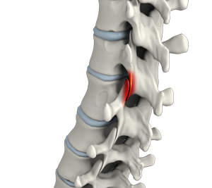 Facet joint Arthritis