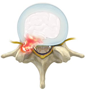 Herniated Disc 