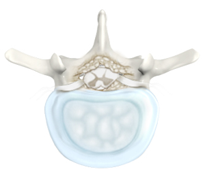 Lumbar Degenerative Disc Disease