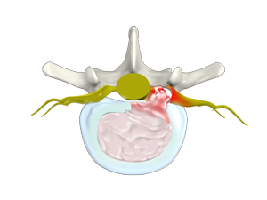 Lumbar Disc Herniation