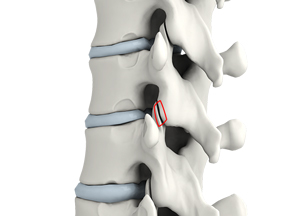 Lumbar Foraminotomy, Facetectomy