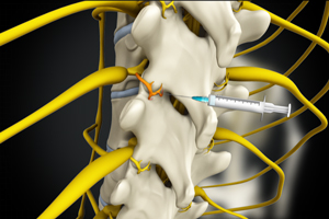 Medial Branch Block Injections