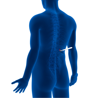 Minimally Invasive Spine Surgery