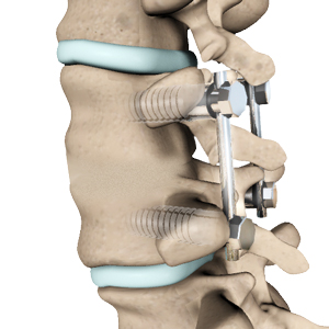 Posterior Lumbar Fusion