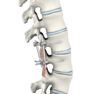 Posterior Lumbar Interbody Fusion