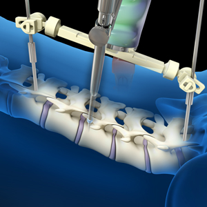Robotic Spine Surgery 