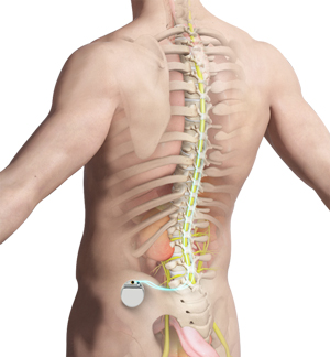  Spinal Cord Stimulator 