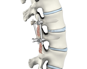 Spinal Fusion