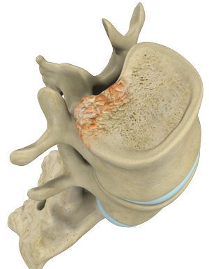 Spinal Tumors 